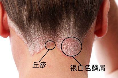 银屑病图片