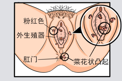 女士尖锐湿疣样子图片