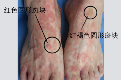 梅毒斑块图片