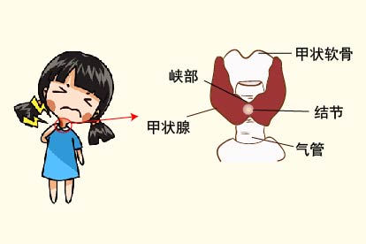 甲状腺结节位置图片