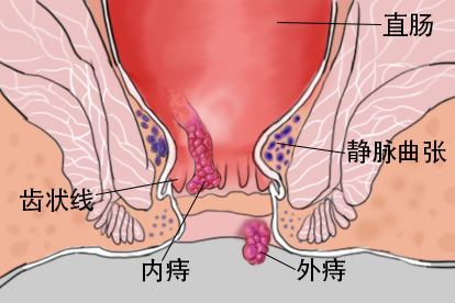 肛门静脉曲张和痔的区别图