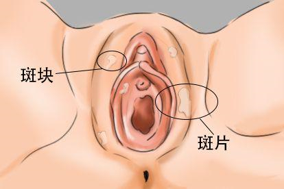 外阴白斑图片