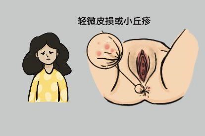 女性肛门尖锐湿疣初期图