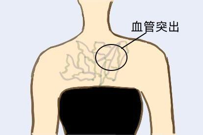 怀孕初期胸部血管图片