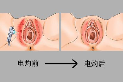 尖锐湿疣电灼恢复后图片