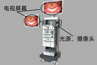 电子喉镜是什么样的图片