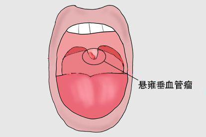 悬雍垂血管瘤图片