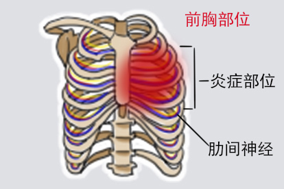 女性肋神经炎的位置图