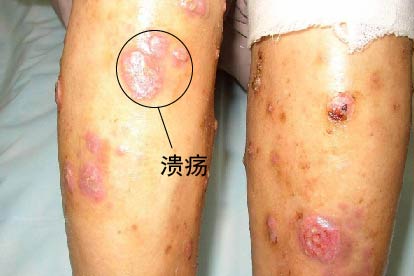 梅毒小腿症状图片