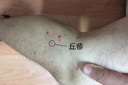 梅毒小腿症状图片