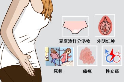 珍珠菌感染症状图片