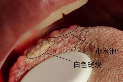 男性hpv感染舌头初期图片