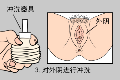 妇科洗液正确使用方法图片
