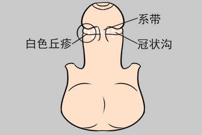 系带根长珍珠样阴茎丘疹图片