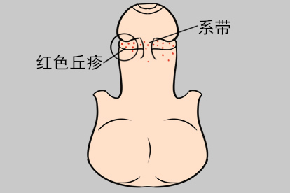 系带根长毛囊炎图片