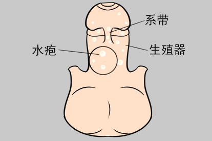 系带根长生殖器疱疹图片