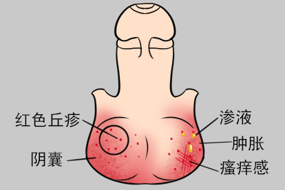 阴囊湿疹小肉粒图片