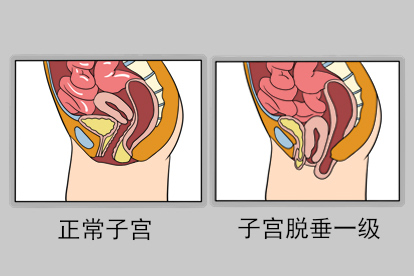 子宫脱垂一级示意图