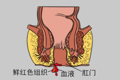 直肠脱垂图片