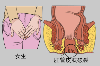 女生肛管皮肤破裂初期图片
