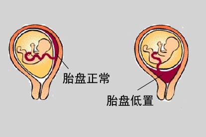 胎盘低置图片和胎盘正常图片