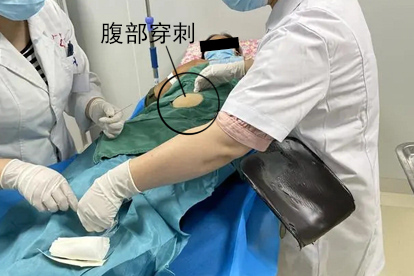 妇科积液穿刺抽液排出来图片