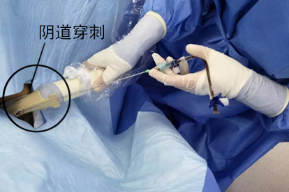 妇科积液穿刺抽液排出来图片