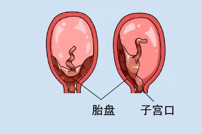 前置胎盘图片