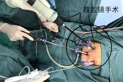 妇科积液手术治疗排出来图片