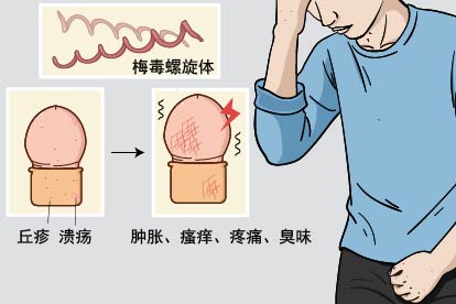 男性软下疳症状图片