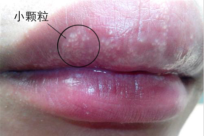 嘴唇有脂肪粒小颗粒图片