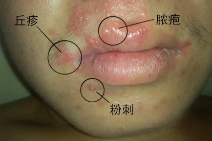 嘴唇有寻常痤疮小颗粒图片