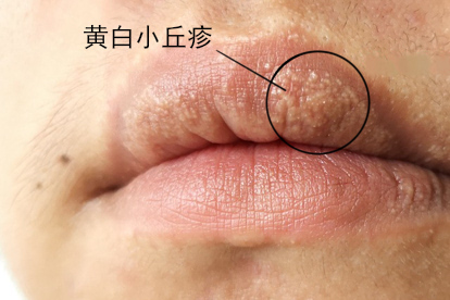 嘴唇有皮脂腺异位症小颗粒图片