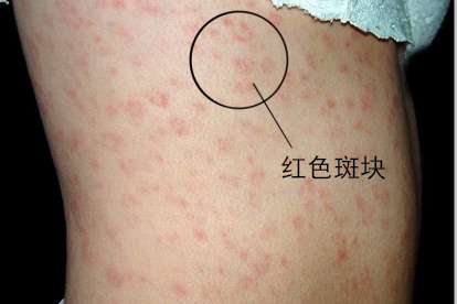 梅毒疹的图片