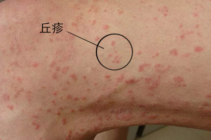 梅毒疹的图片