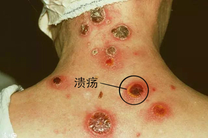 梅毒疹的图片