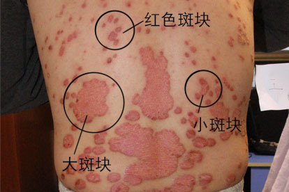 斑块状银屑病图片