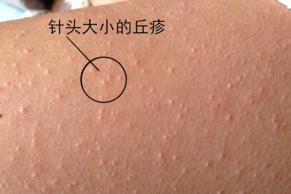 疥疮疙瘩图片