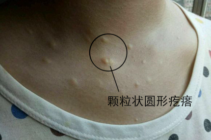 毛囊炎疙瘩图片