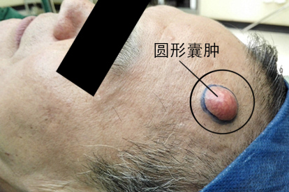 皮脂腺囊肿疙瘩图片