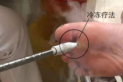 寻常疣物理治疗图