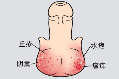 阴囊瘙痒湿疹图片