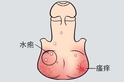 阴囊瘙痒生殖器疱疹图片