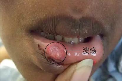 口腔梅毒硬下疳症状图片
