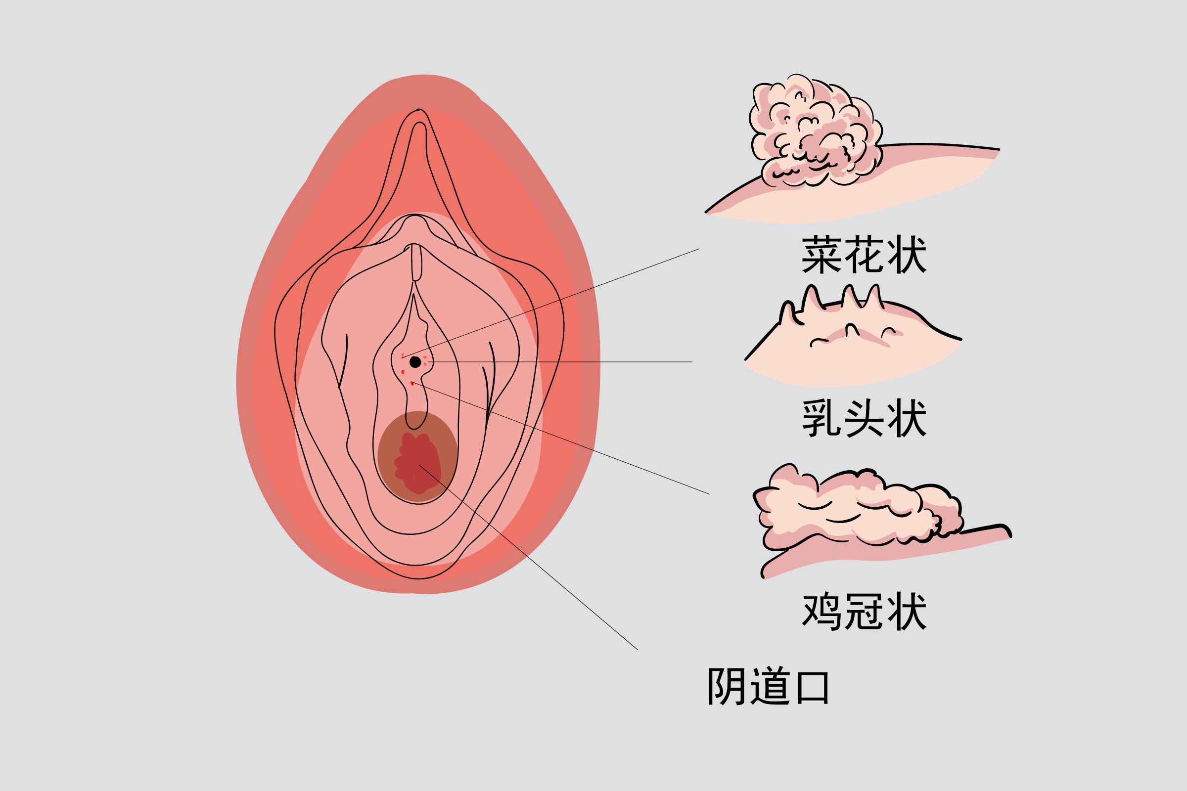 阴道口尖锐湿疣图片