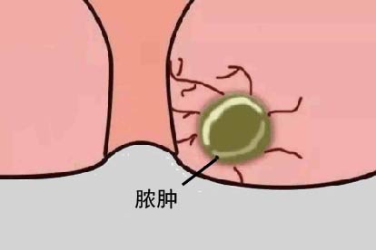 肛囊肿是怎么回事，有危险吗图片