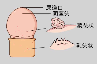 男性尖锐湿疣早期症状图