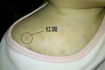 湿疹症状图