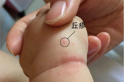 湿疹症状图