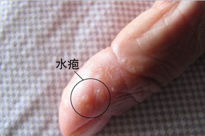 湿疹症状图